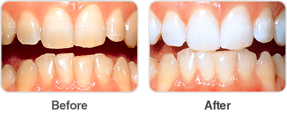 6 hydrogen peroxide tooth whitening gel